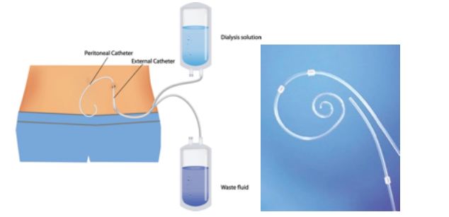 Peritoneal Catheter Placement