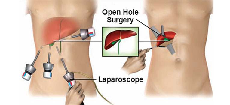 Laparoscopy Or Open Surgery Which One Is Best Southlake General