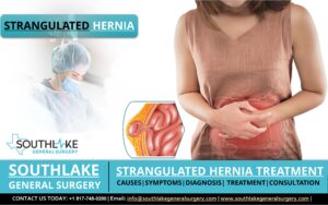 Strangulated Hernia Causes Symptoms Diagnosis Treatment In Texas