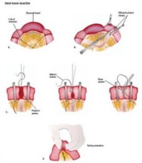 Small Bowel Surgery, Laparoscopic Bowel Obstruction treatment Cost ...