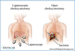 gallbladder laparoscopic bile leakage