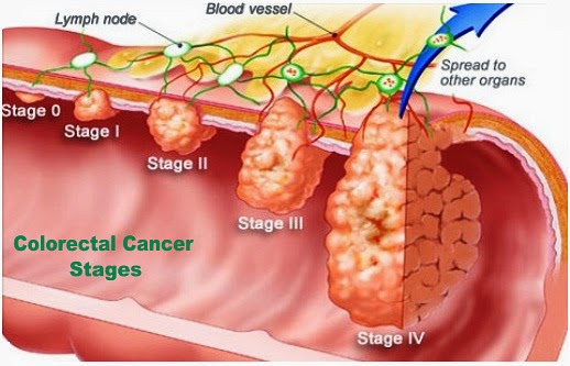 Know More Colorectal Colon Cancer Southlake General Surgery 7441