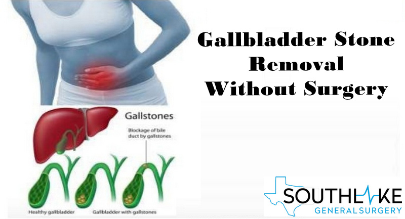 gallstones natural treatment