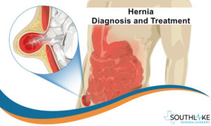 Hernia Problem Diagnosis And Treatment Southlake General Surgery Texas