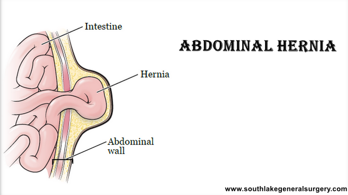Abdominal Hernia- Symptoms, Diagnosis and Treatment