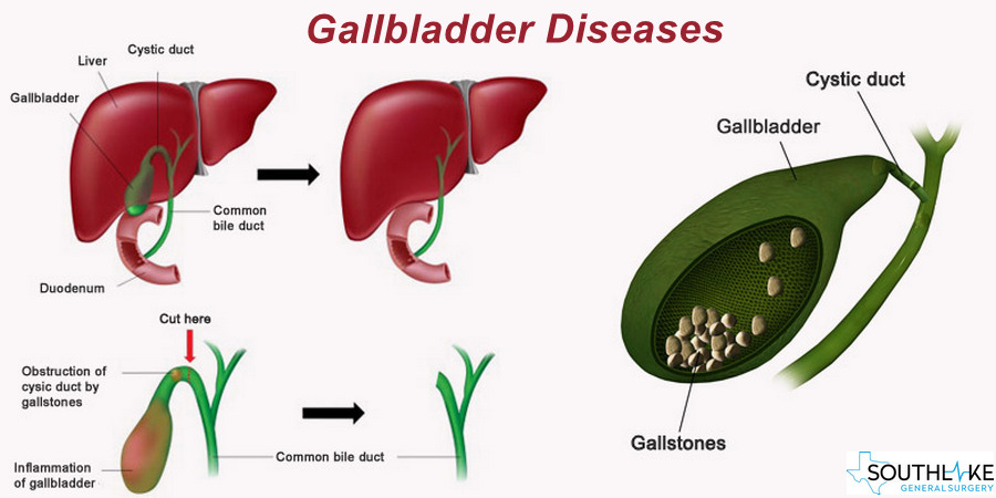 gallbladder issues symptoms