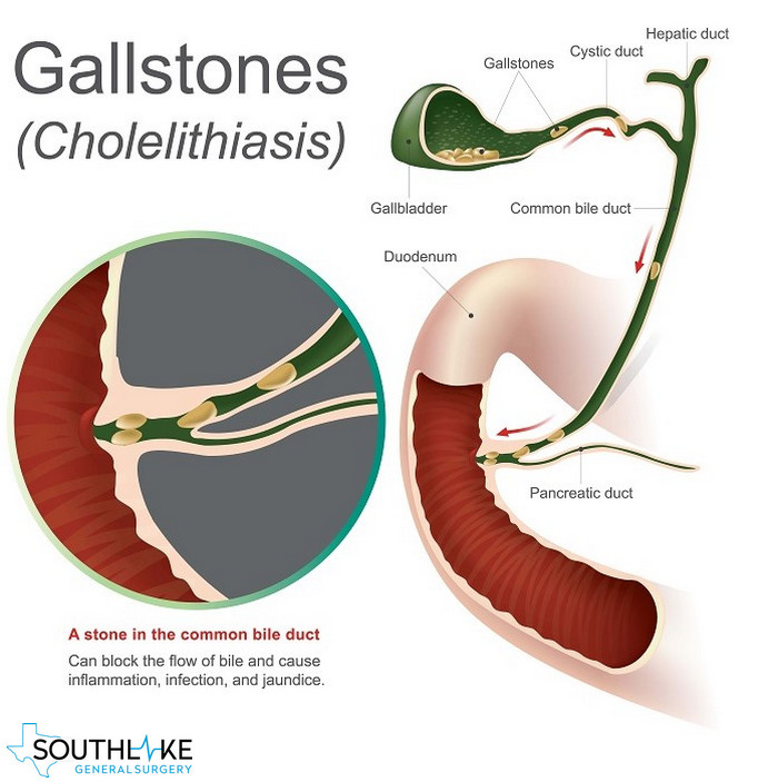 Gallbladder Diseases Types Symptoms And Treatment Southlake Texas