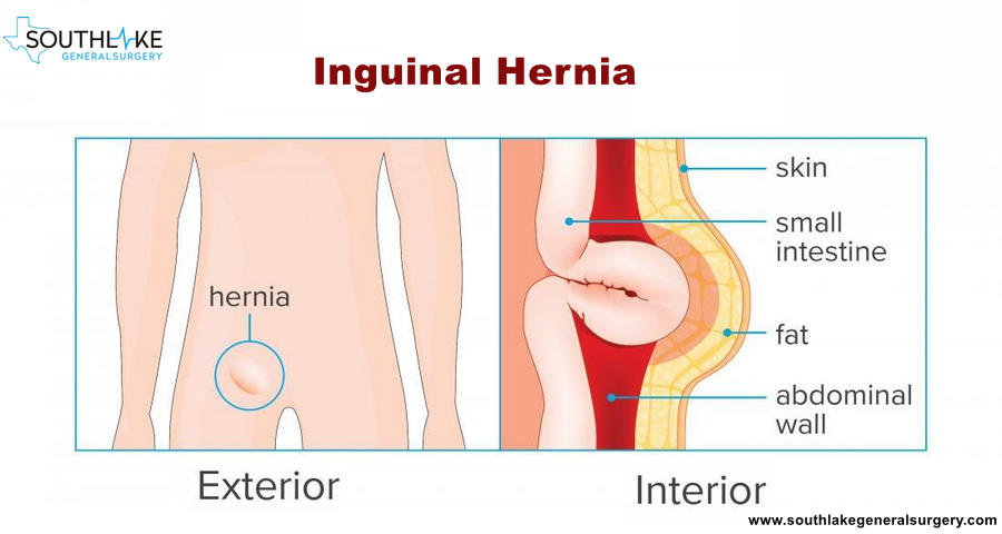 Inguinal hernia- Causes, Types, Symptoms, Diagnose & Treatment