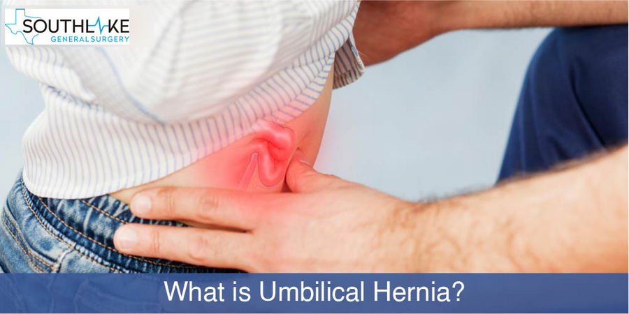 Umbilical Hernia (swollen belly button) - How to tell if you have one