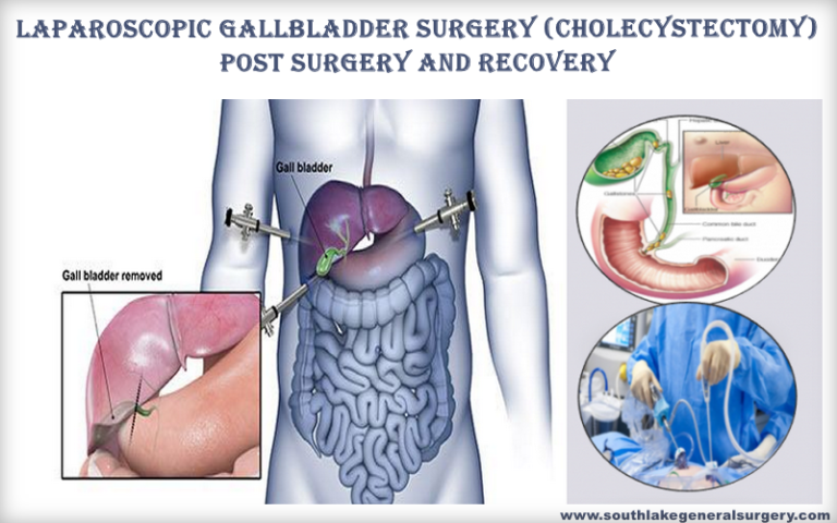 living-after-gallbladder-removal-gallbladder-how-to-remove-healthy