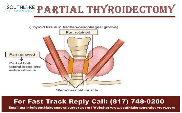 Partial Thyroid Removal Surgery and Recovery - Southlake General Surgery