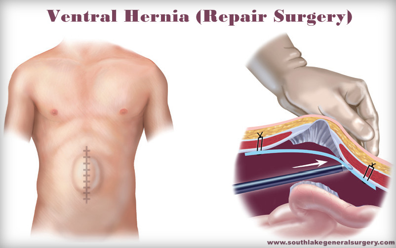 Ventral Hernia, Hernia Surgery