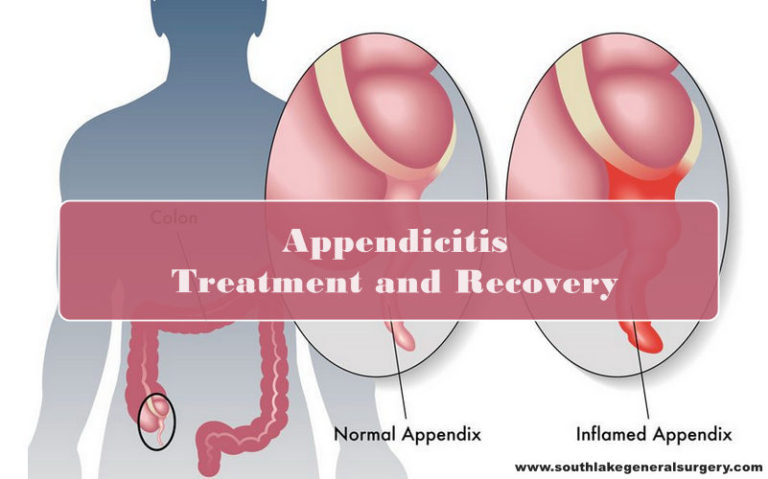 Appendicitis Symptoms Treatment And Recovery Southlake General Surgery