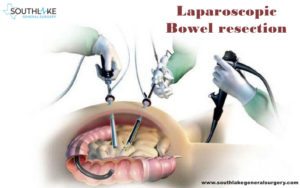 Bowel resection- Why is required? - Recovery Post Surgery - Southlake General Surgery