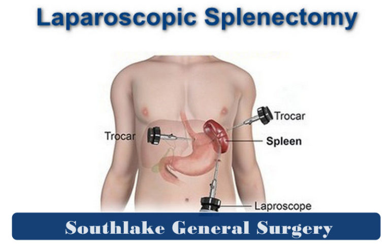Pre And Post Spleen Surgery Treatment Southlake General Surgery 9523