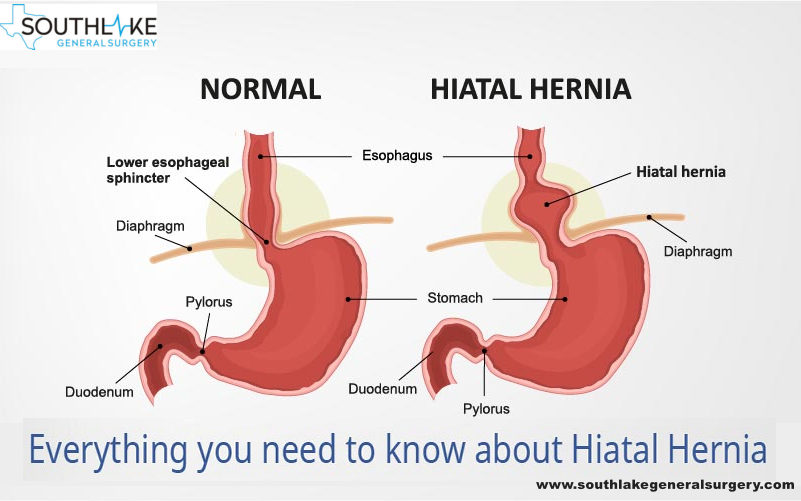 Hiatal Hernia Laparoscopic Surgery Southlake General Surgery Texas