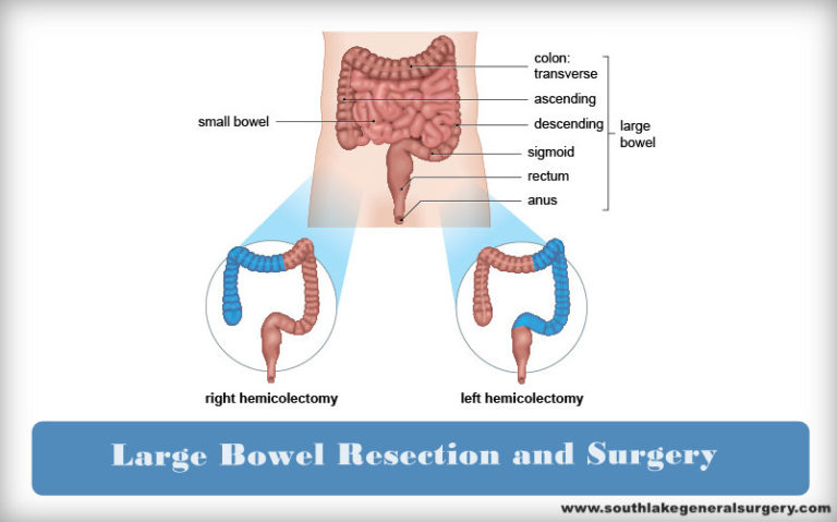 Large Bowel Resection Surgery And Recovery Southlake General Surgery 4517