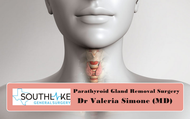 Parathyroid Gland Removal Surgery Dr Valeria Simone Md