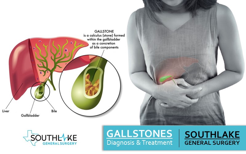 Medicine For Gallstones Wholesale Online, Save 68% | jlcatj.gob.mx