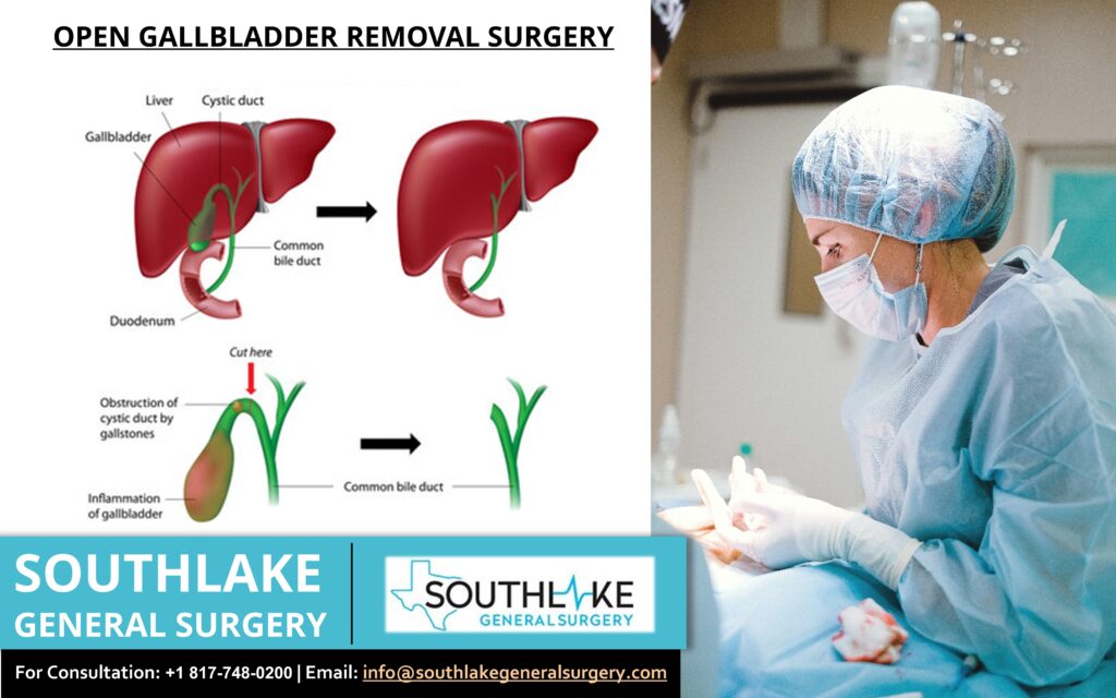 Is gallbladder removal a major surgery?