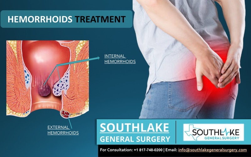 The swollen vein in the lower section of the rectum and anus is known as Hemorrhoids are also called Piles. Southlake General Surgery,Texas