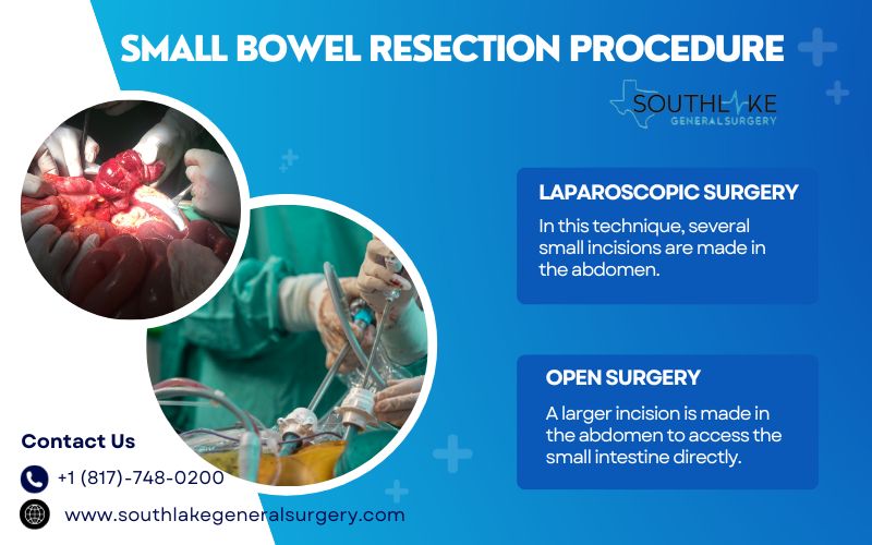 Comparison image of laparoscopic and open small bowel resection techniques with incisions and medical instruments.