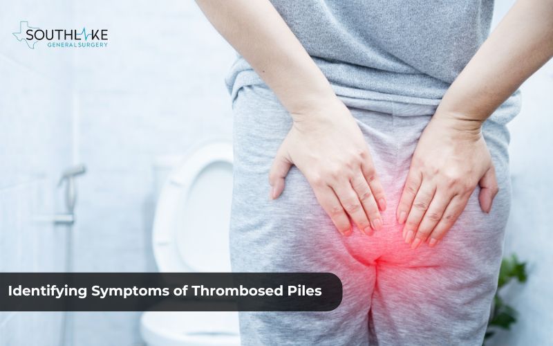 Image depicting a person experiencing symptoms of thrombosed piles, such as severe pain and discomfort during bowel movements.