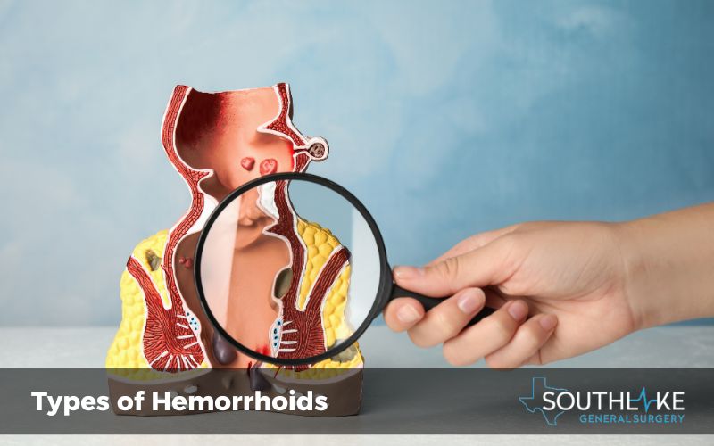 Diagram illustrating internal and external hemorrhoids - Understanding different types of hemorrhoids