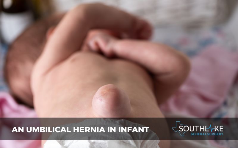 Diagram showing an umbilical hernia in an infant's abdomen.