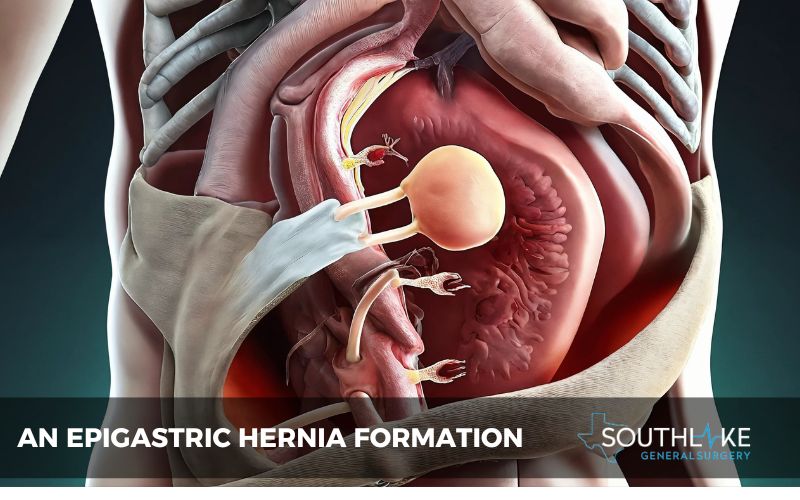 Illustration of an epigastric hernia forming in the abdominal wall.