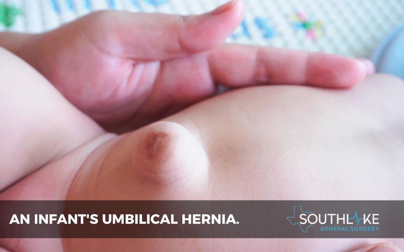 Close-up image of an infant's umbilical hernia.