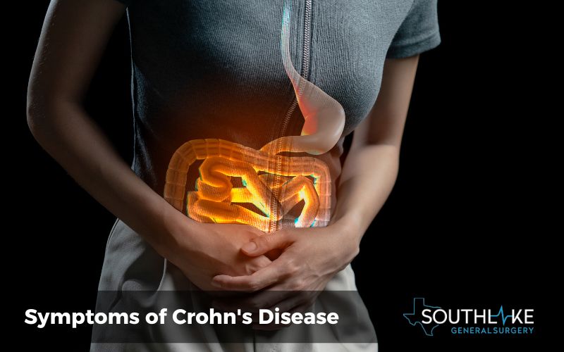 Icons illustrating common symptoms of Crohn's disease: abdominal pain, diarrhea, weight loss.