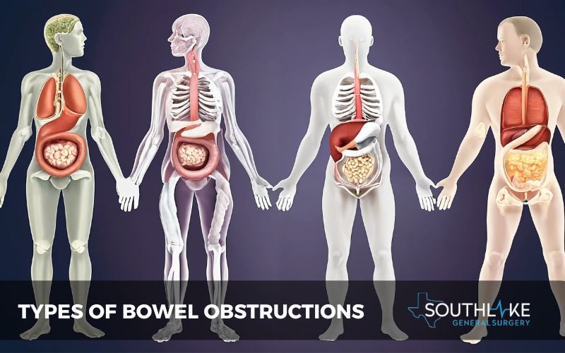 Illustration of different types of bowel obstructions.