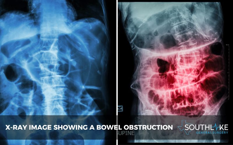 X-ray image showing a bowel obstruction.