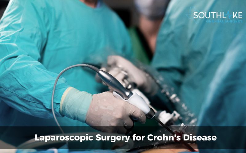 Surgeons performing a laparoscopic surgery for Crohn's disease.