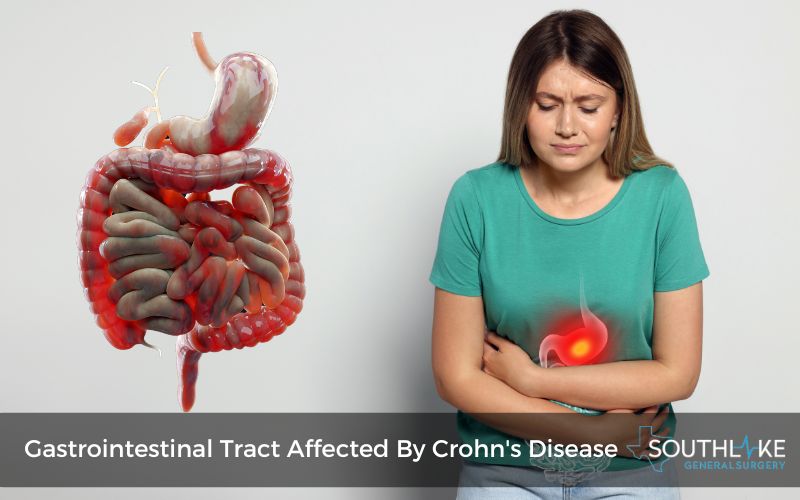 Diagram of the gastrointestinal tract affected by Crohn's disease.