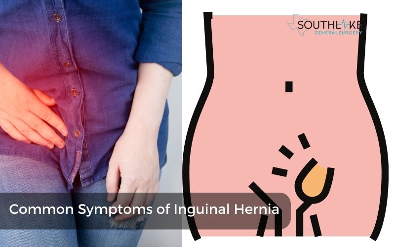 Medical diagram highlighting common symptoms of groin hernia like groin bulge and abdominal pain.