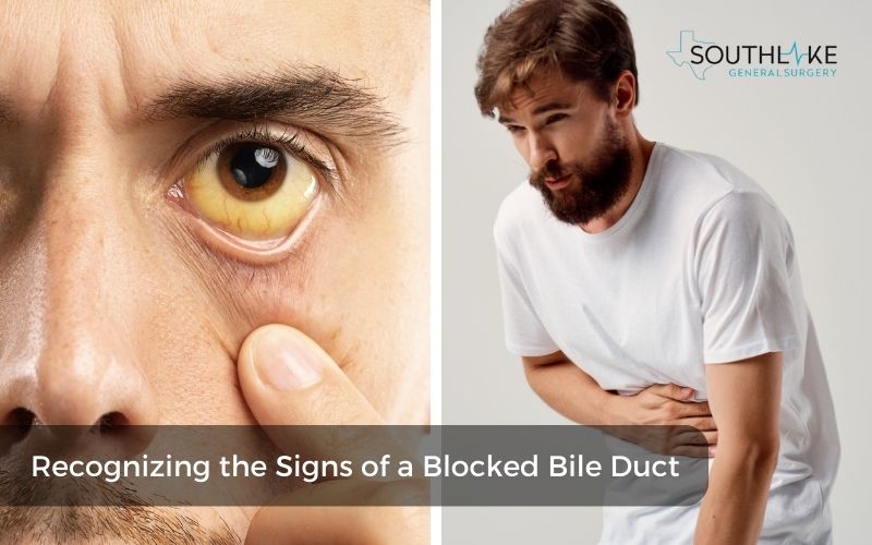 Symptoms of the blocked bile duct: jaundice, abdominal pain, dark urine.