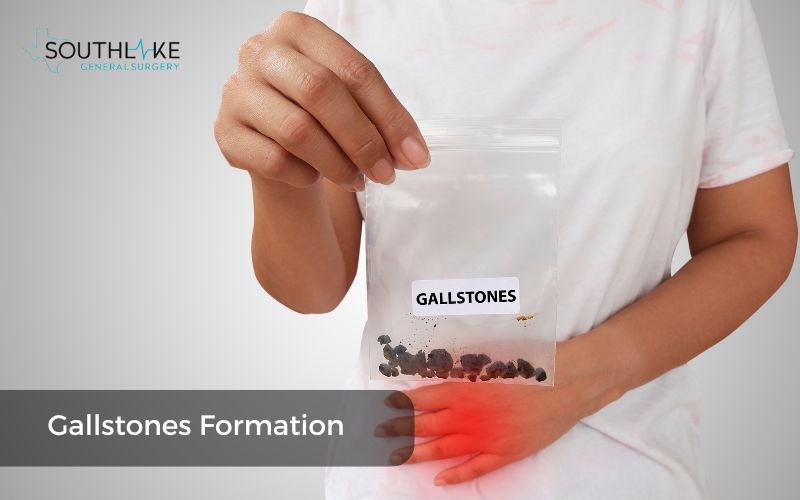 Close-up image showing gallstones of different sizes, illustrating their formation and composition.