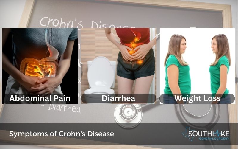 Common symptoms of Crohn's disease.