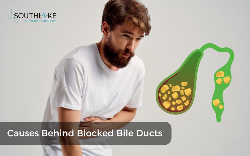 Illustration of gallstones causing bile duct blockage.