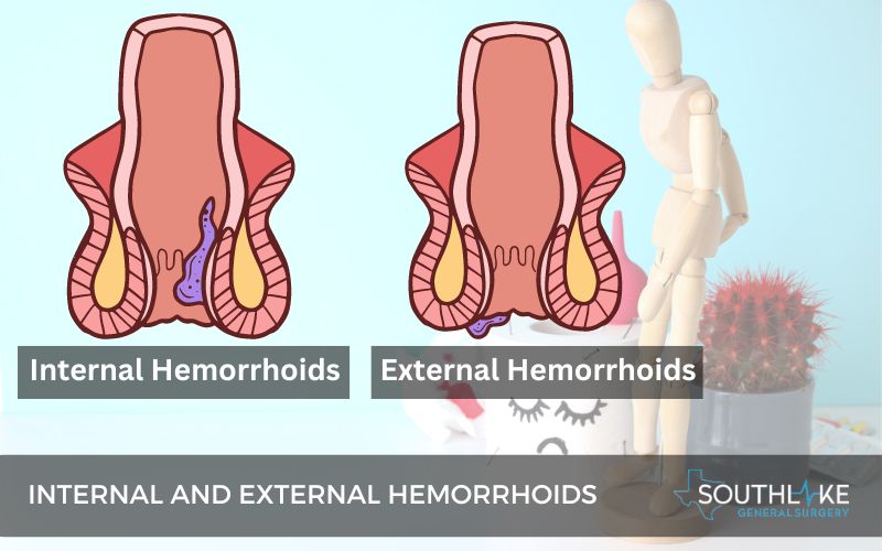 Illustration of internal and external hemorrhoids.