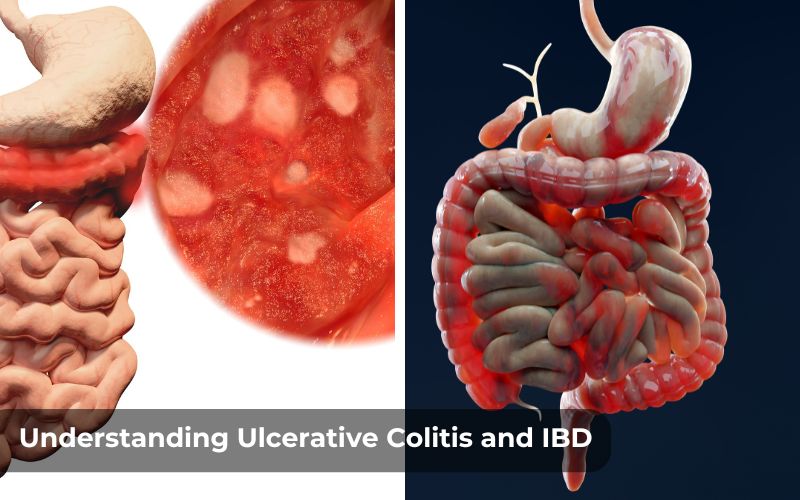 Comparison image of Ulcerative Colitis and Crohn's Disease highlighting differences.