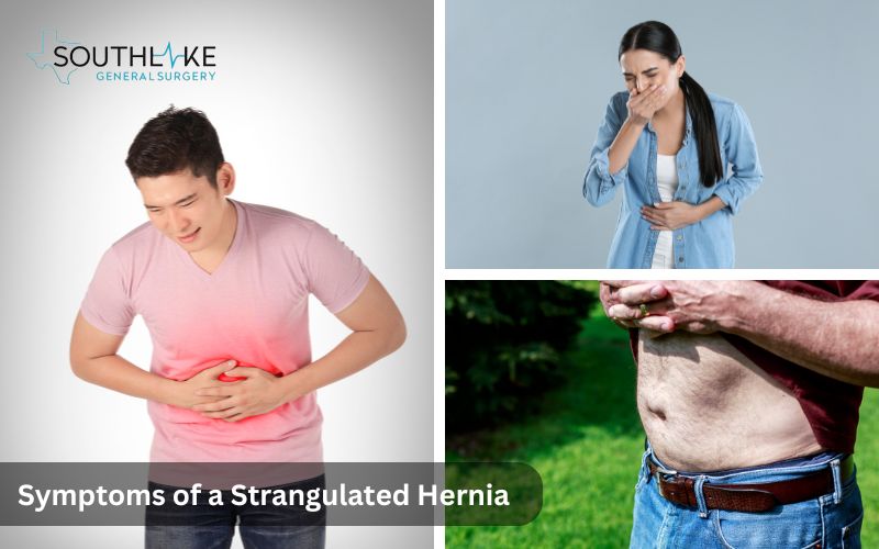 Diagram depicting symptoms of a strangulated hernia, including severe pain, nausea, and noticeable bulge.