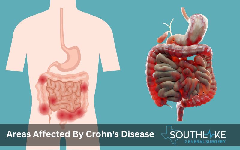 Diagram of the gastrointestinal tract showing areas affected by Crohn's disease.