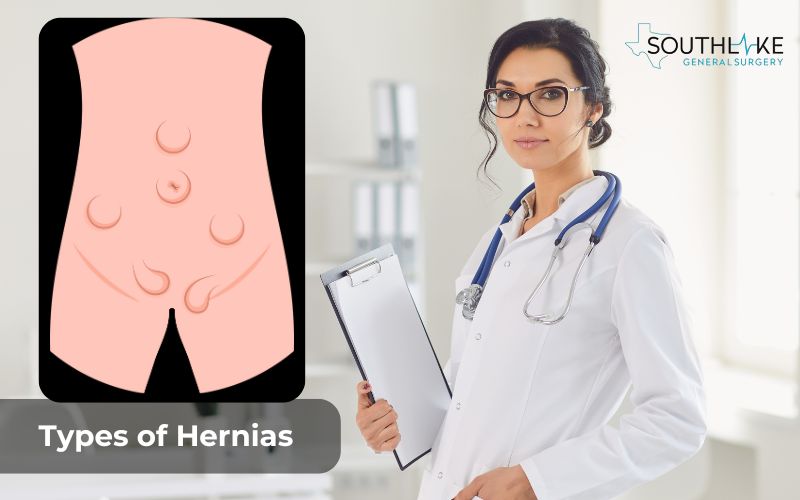 Image of various types of hernias: inguinal, umbilical, and hiatal hernias.