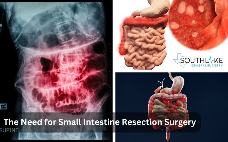 Indicators for Small Intestine Resection Surgery - Symptoms and Conditions