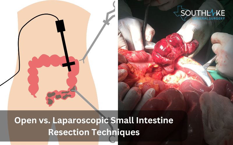 Open vs. Laparoscopic Small Intestine Resection Techniques.