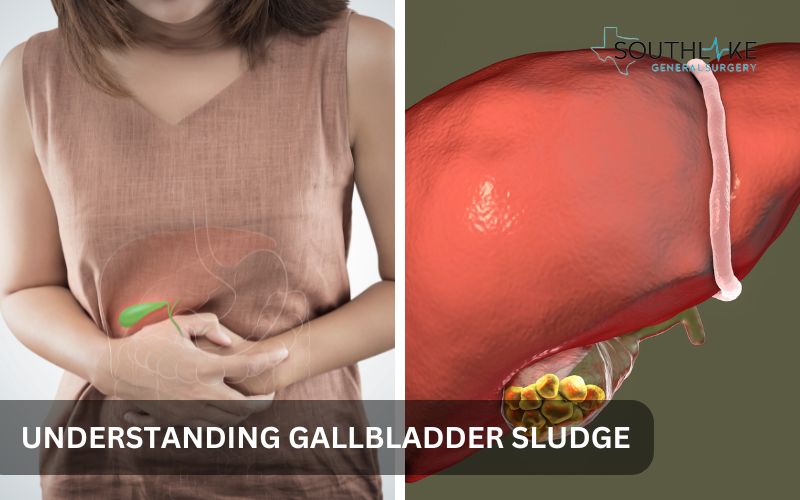 Detailed diagram showing the composition of gallbladder sludge, including cholesterol crystals and calcium salts.