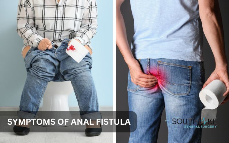 Diagram depicting symptoms of an anal fistula, including pain, swelling, redness, and fluid drainage.